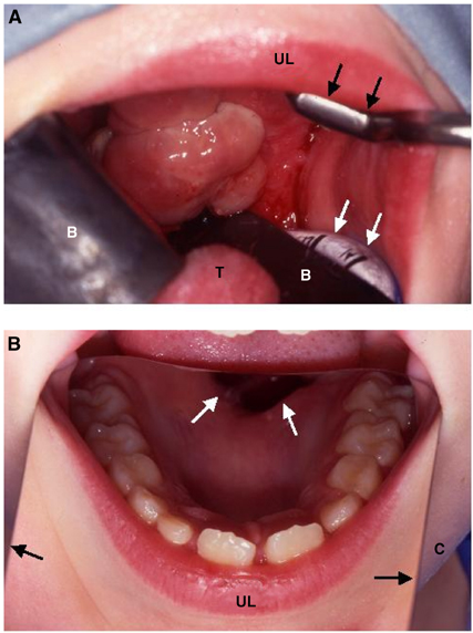 head and neck cancer